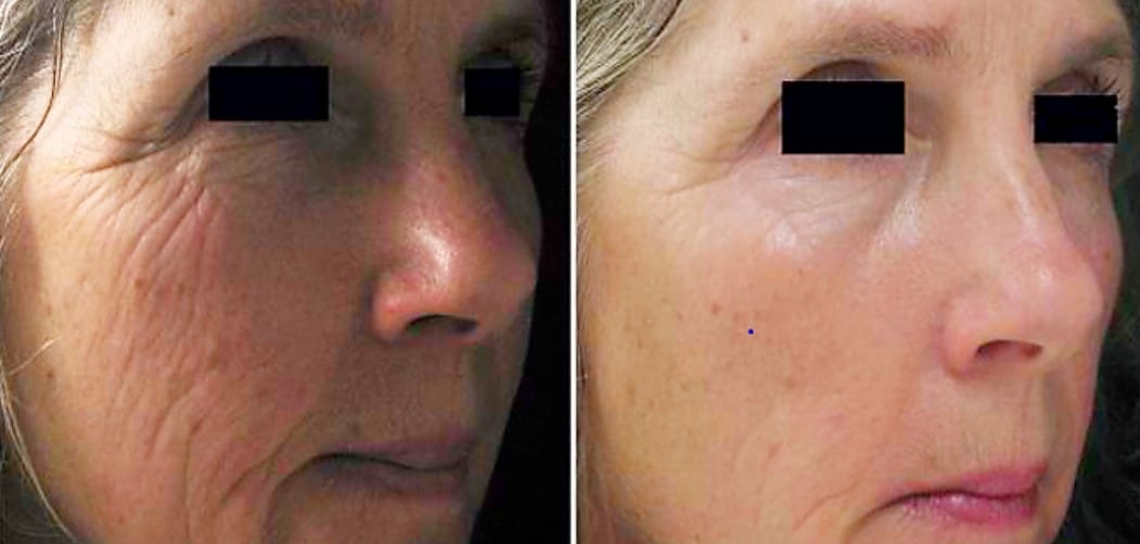 Voor en na Dermaclear behandeling – nog krachtiger dan Hydrafacial