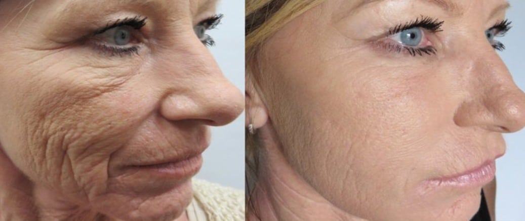 Voor en na Dermaclear behandeling – nog krachtiger dan Hydrafacial