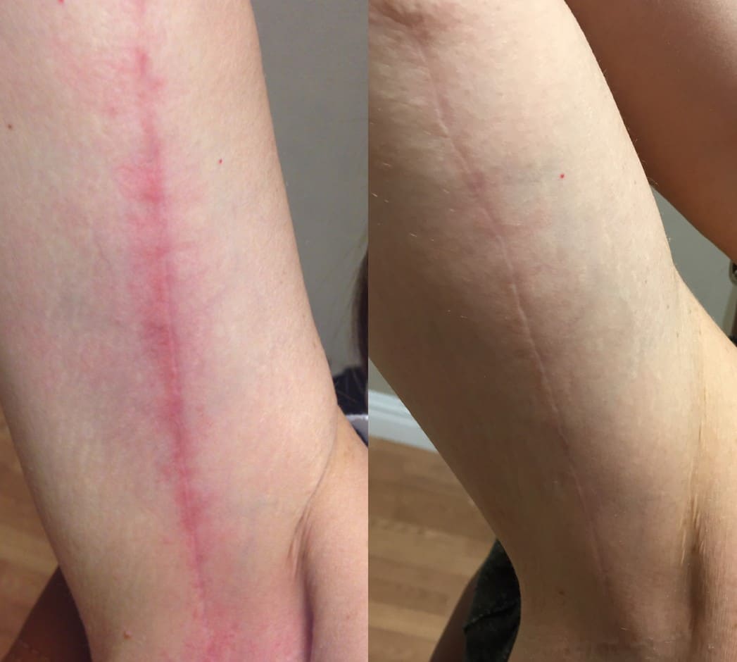 Voor en na Lumecca IPL behandeling in Den Haag.