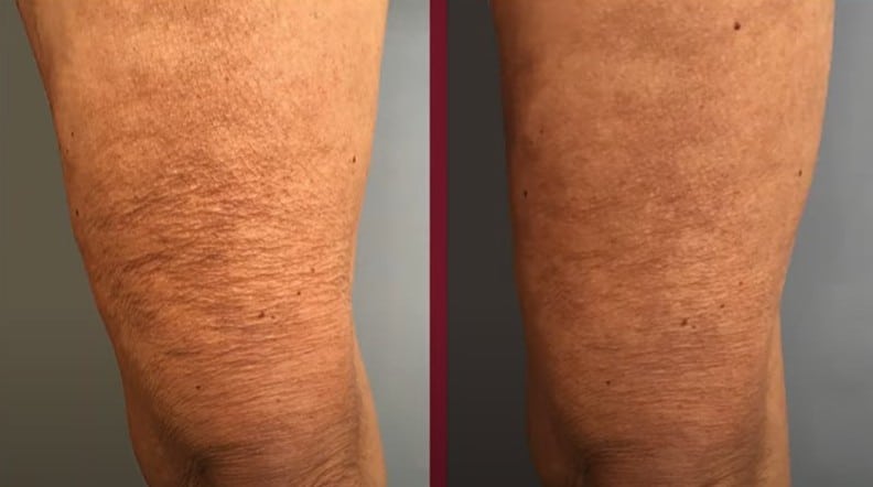 Voor en na Dermalux LED therapie in Den Haag.