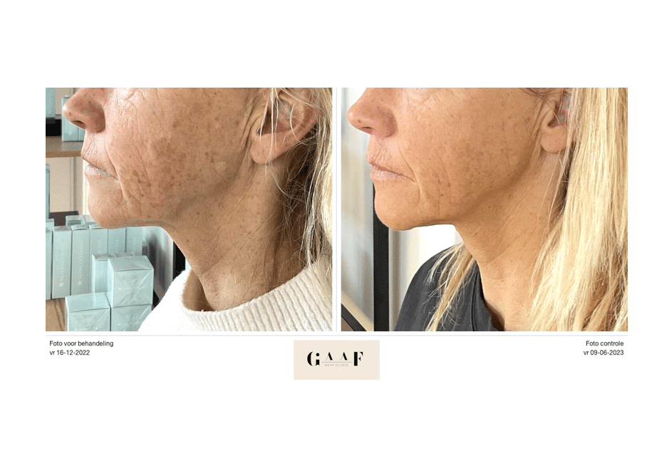 Voor en na Morpheus8 behandeling