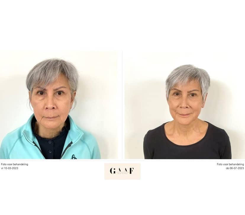 Voor en na Lumecca IPL behandeling in Den Haag.